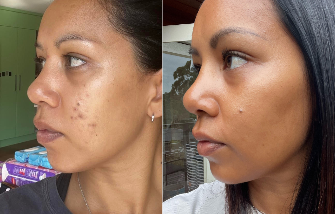 Natasha's Journey with Cystic breakouts & scarring