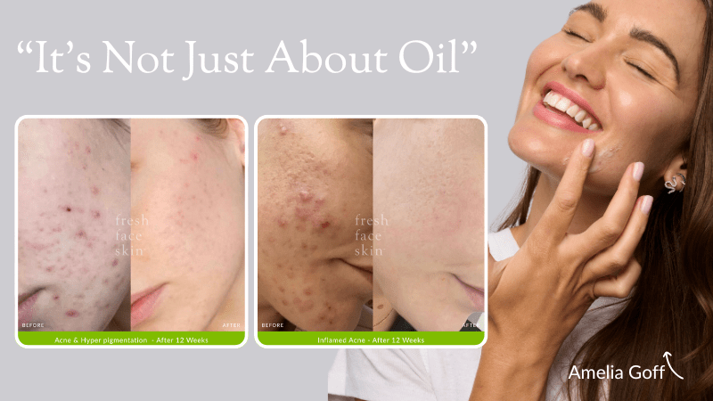 Why Hormonal Acne Comes Back Like ‘Second Puberty’ - Fresh Face Skin