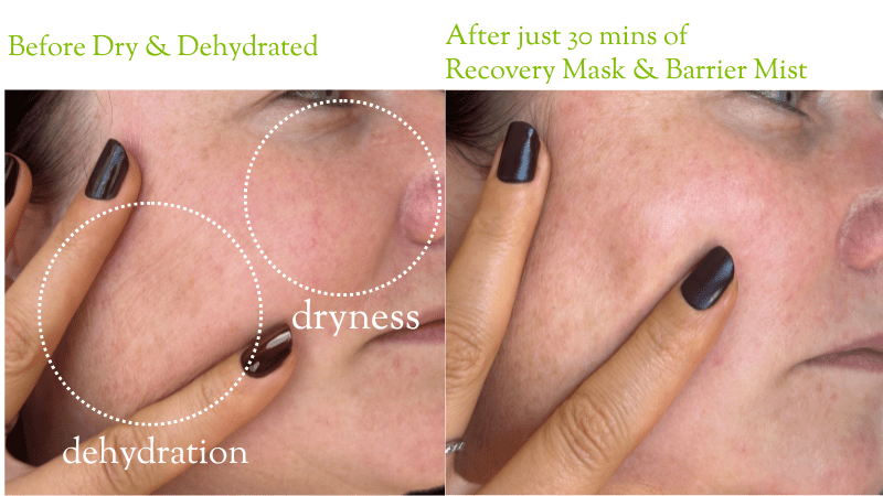 The Difference Between Dry and Dehydrated Skin—and Why It Matters - Fresh Face Skin
