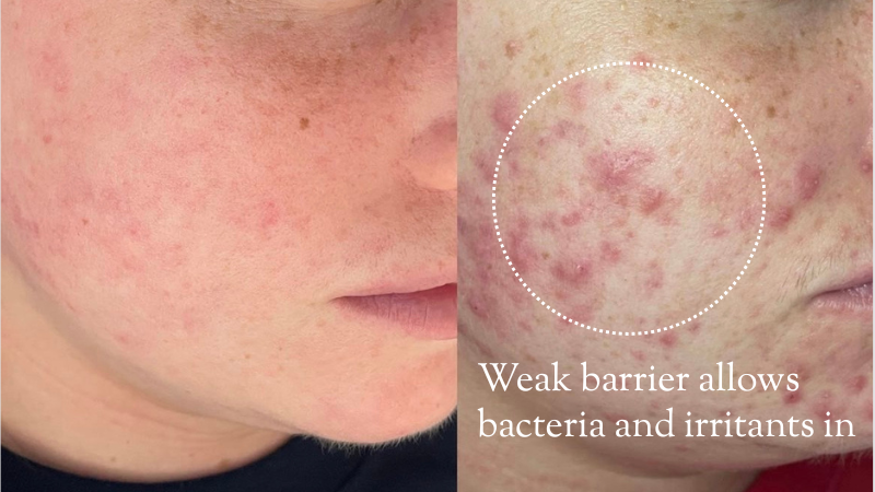 How do l tell if l a have a week skin barrier