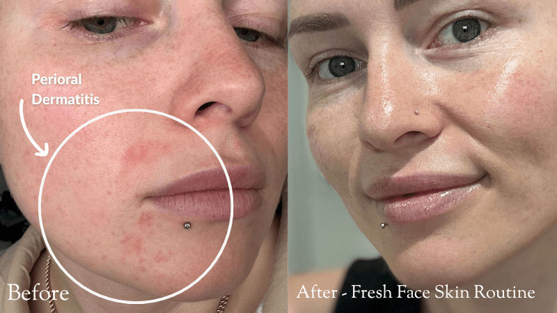 Perioral Dermatitis Flare-Ups? Here’s How to Track (and Tame) the Culprit - Fresh Face Skin