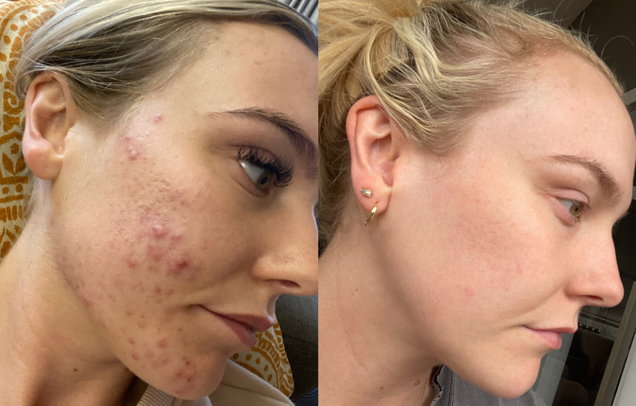 cystic acne at 26 and how switching to Fresh Face Skin transformed my skin.