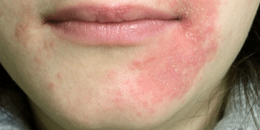 Perioral Dermatitis, Acne, or Eczema: How to Tell the Difference - Fresh Face Skin