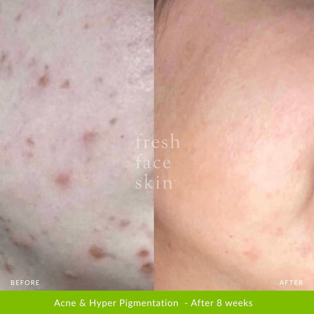 Healer Treatment - Fresh Face Skin