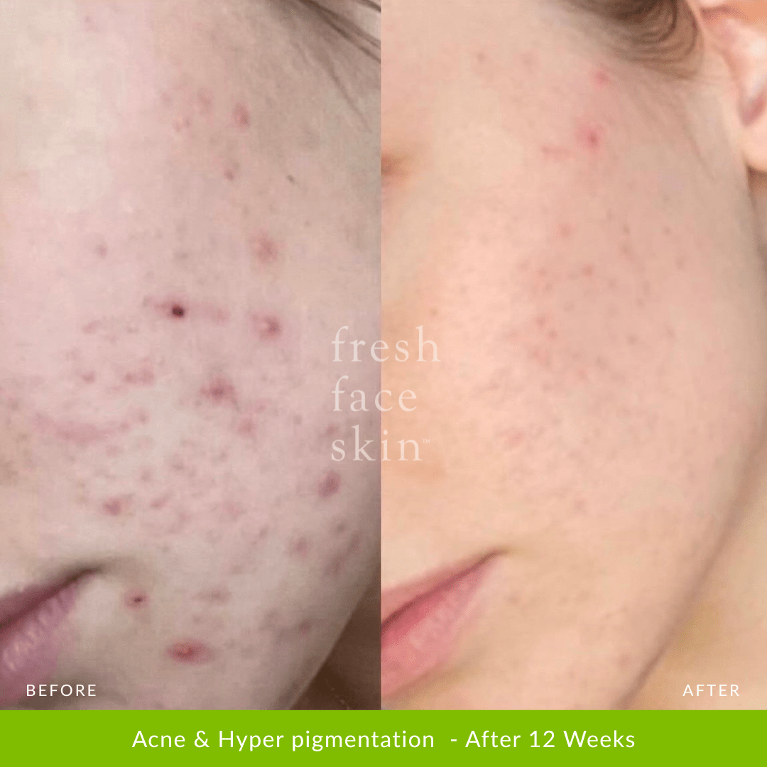 Healer Treatment - Fresh Face Skin