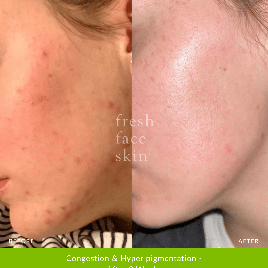 Skin Barrier Repair Pack - Fresh Face Skin