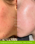Congestion & Hyper pigmentation - After 8 Weeks