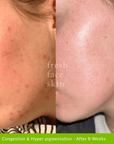 Skin Barrier Repair Pack - Fresh Face Skin