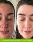 Acne Clearing Pack
