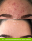 Acne Clearing Pack