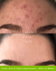 Acne Clearing Pack - Fresh Face Skin