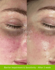 Skin Barrier Repair Pack - Fresh Face Skin