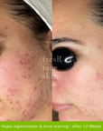 Acne Clearing Pack