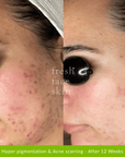 Acne Clearing Pack - Fresh Face Skin