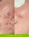 Acne Clearing Pack - Fresh Face Skin