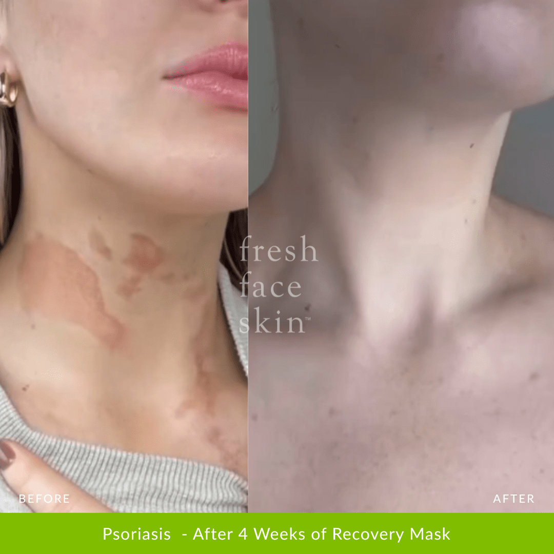 Skin Barrier Repair Pack - Fresh Face Skin