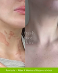 Psoriasis - After 4 Weeks of Recovery Mask