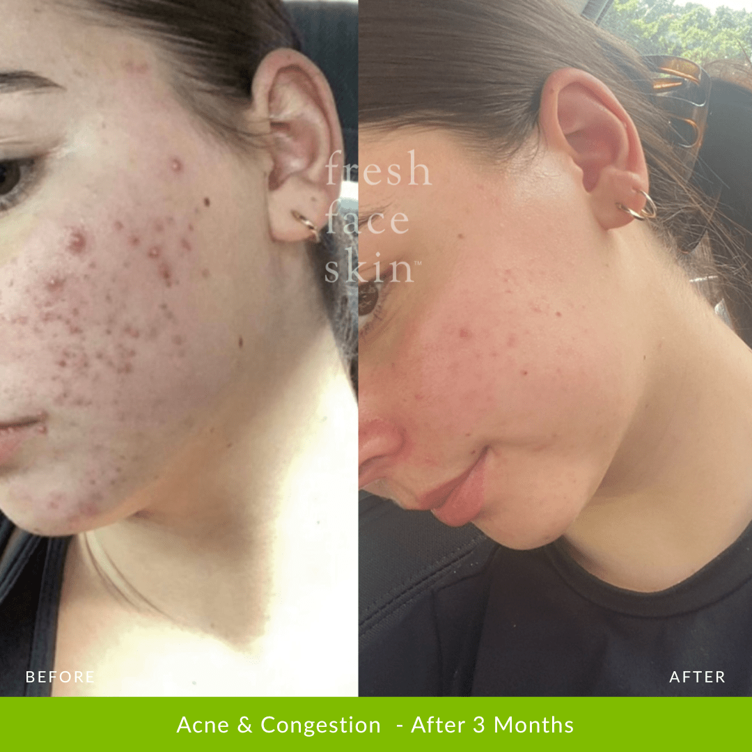 Acne Clearing Pack - Fresh Face Skin