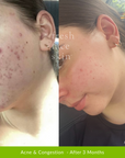 Acne Clearing Pack