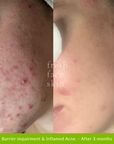 Acne Clearing Pack