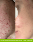 Acne Clearing Pack - Fresh Face Skin