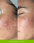 Acne Clearing Pack - Fresh Face Skin