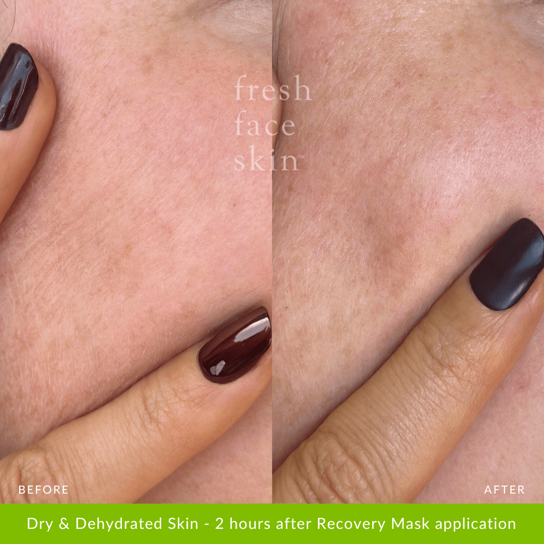 Recovery Mask - Fresh Face Skin