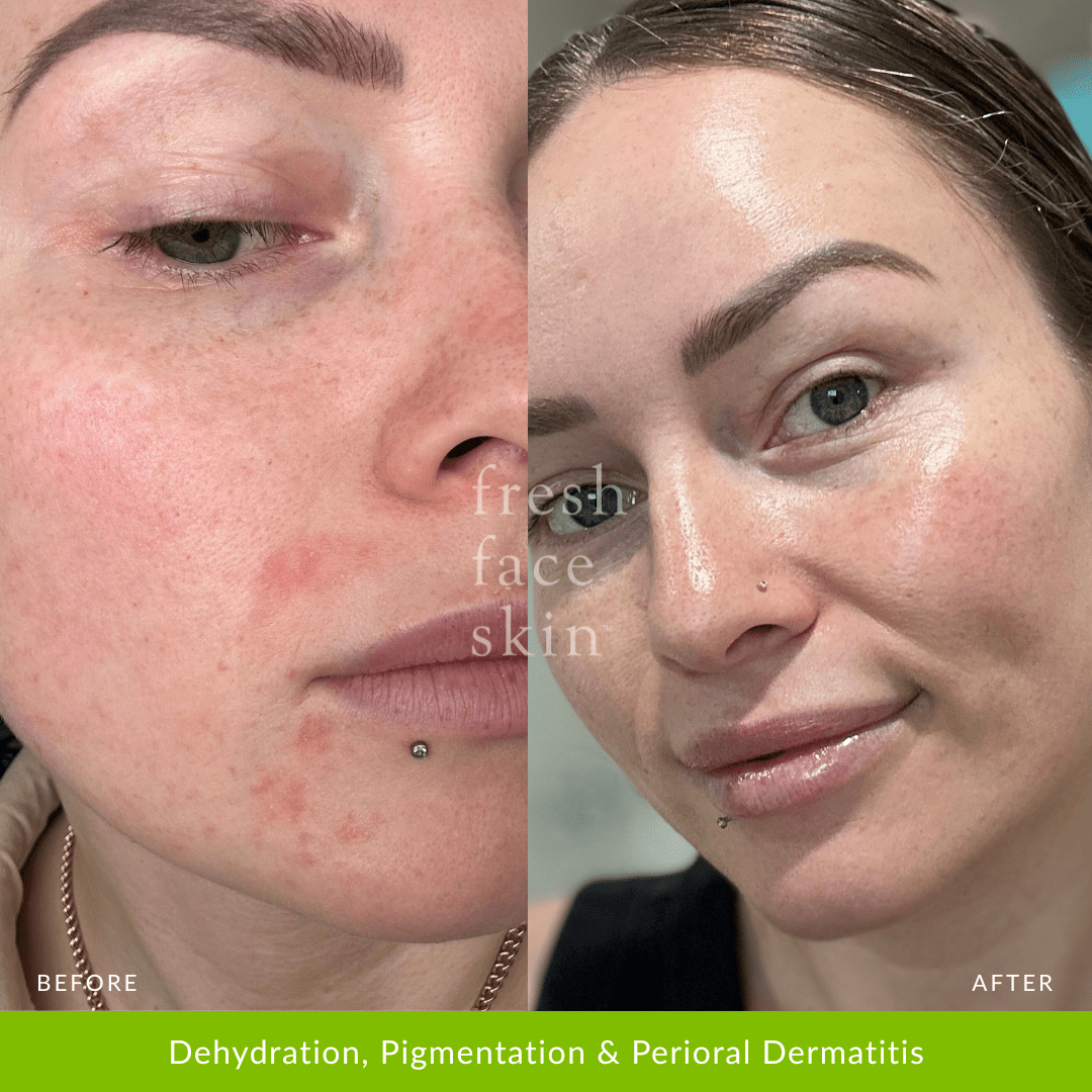 Skin Barrier Repair Pack - Fresh Face Skin