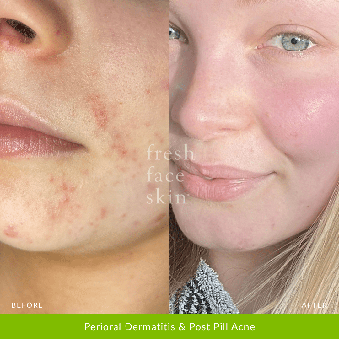 Skin Barrier Repair Pack - Fresh Face Skin