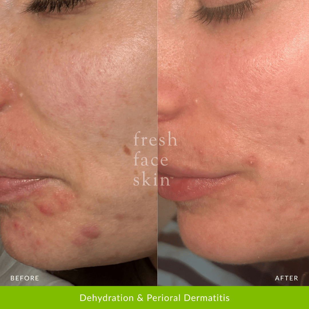 Skin Barrier Repair Pack - Fresh Face Skin