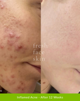 Acne Clearing Pack