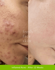 Acne Clearing Pack - Fresh Face Skin