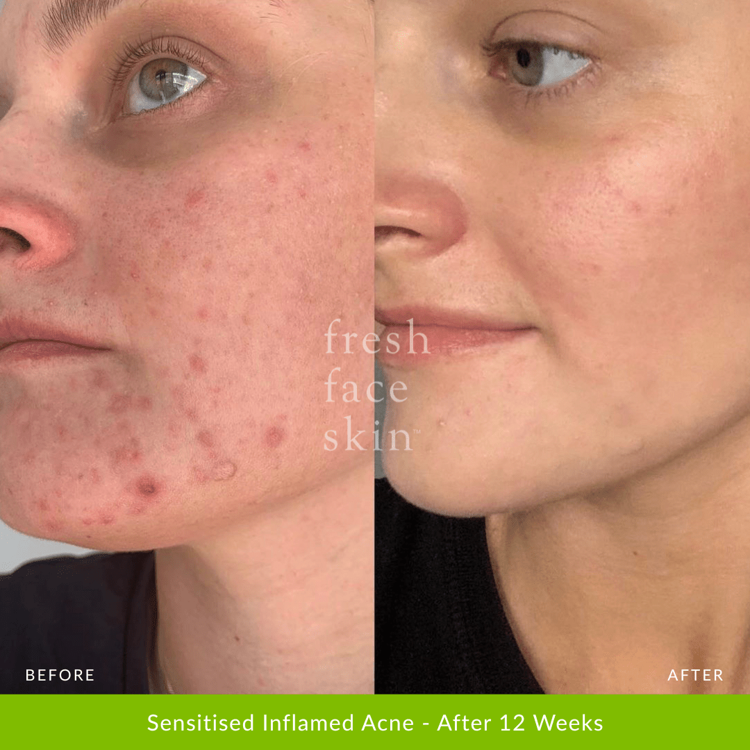 Hydrate Me Starter Pack - Fresh Face Skin