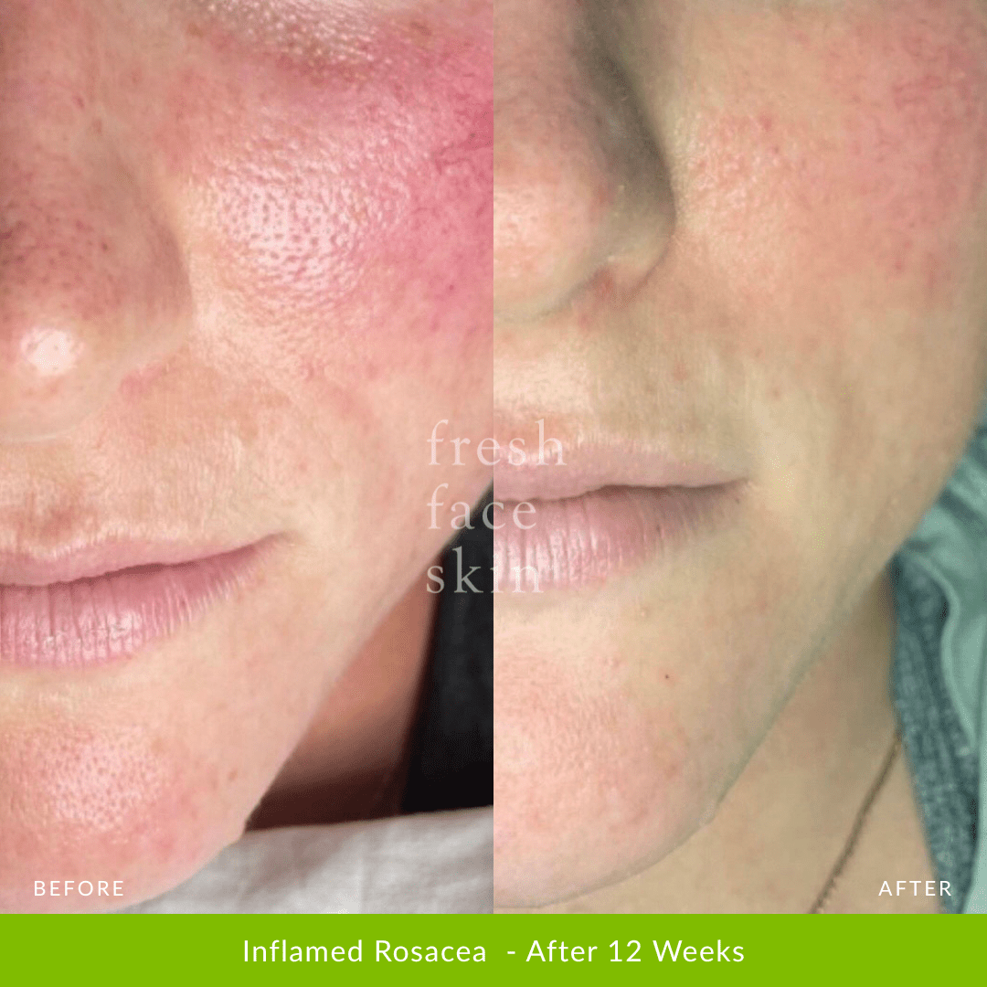 Skin Barrier Repair Pack - Fresh Face Skin