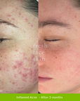 Acne Clearing Pack