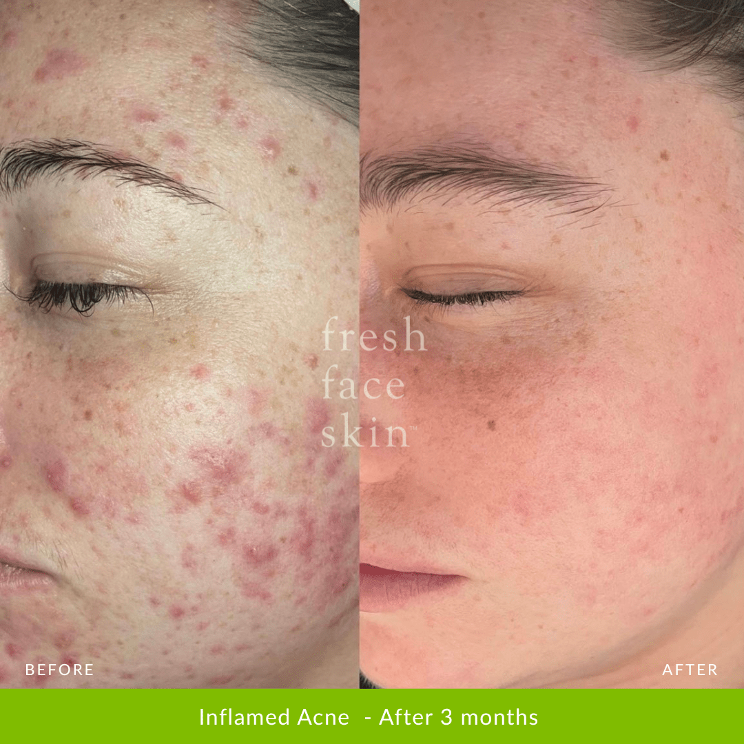 Hydrate Me Starter Pack - Fresh Face Skin