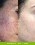 Acne Clearing Pack