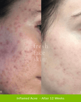 Acne Clearing Pack - Fresh Face Skin