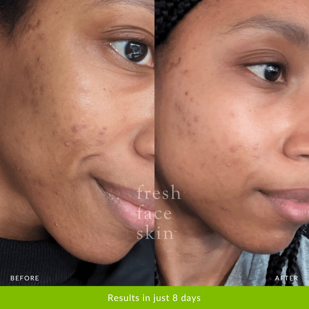 Skin Brightening Pack - Fresh Face Skin