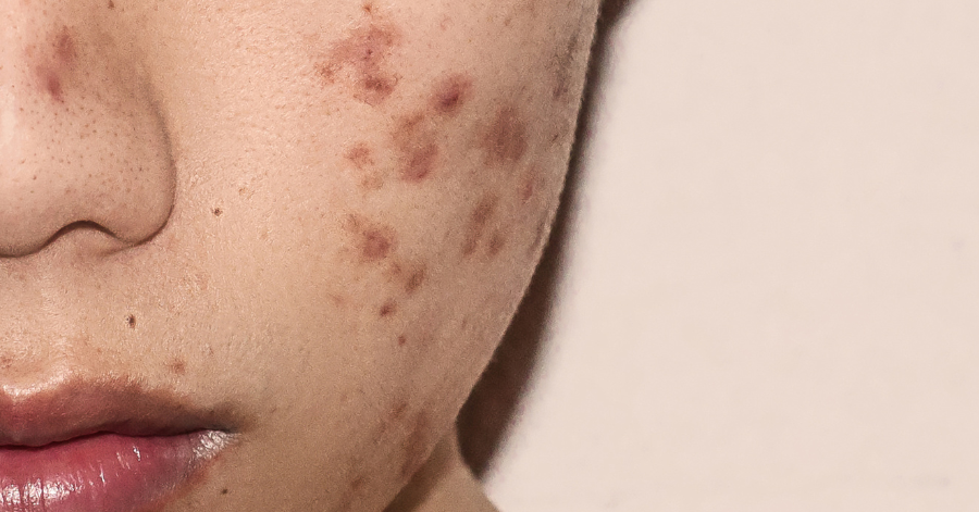 Acne & underlying congestion