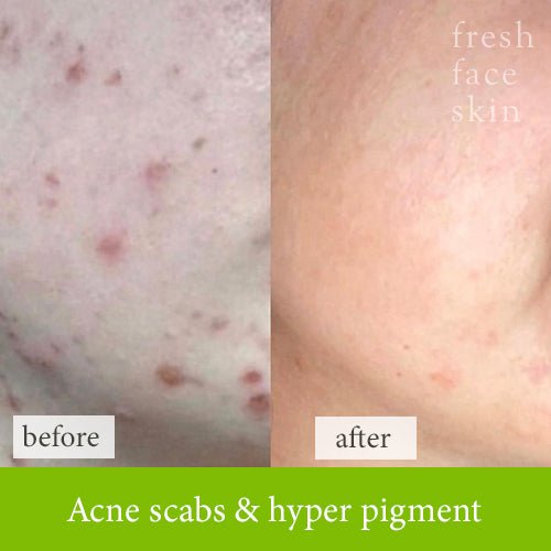 Hydrate & Renew Pack - Fresh Face Skin