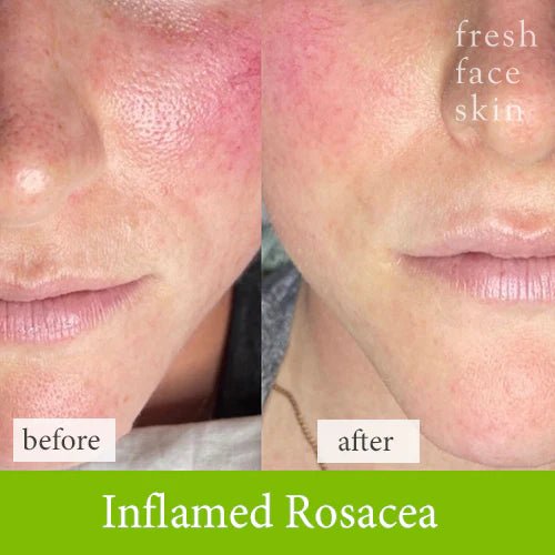 Soothe & Sculpt Pack - Fresh Face Skin