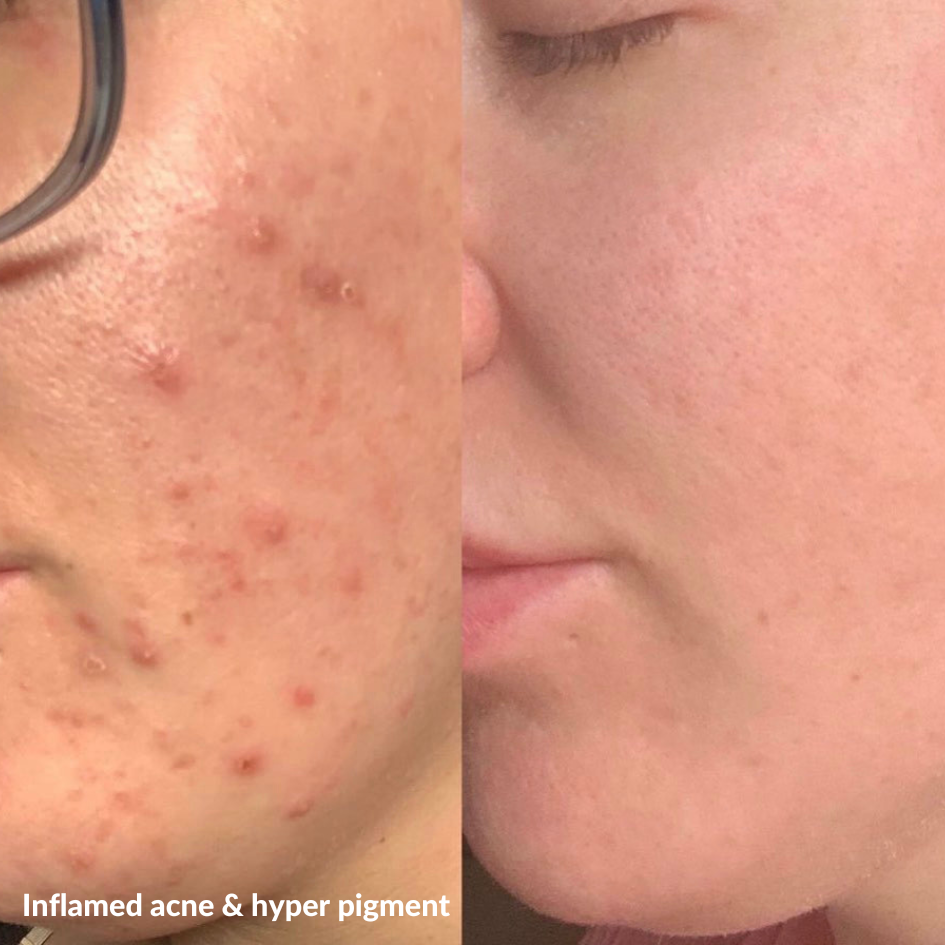 Inflamed acne & hyper pigment treatment routine