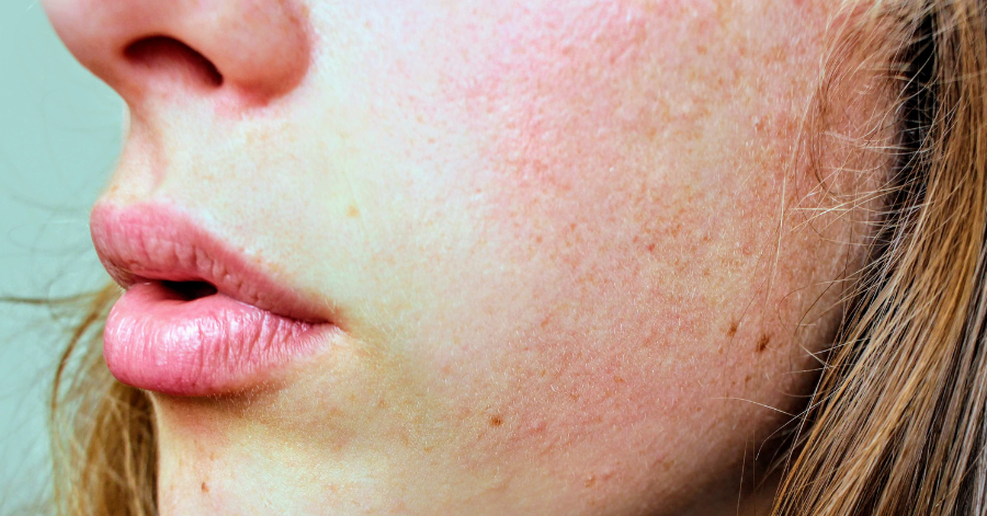Skin Redness