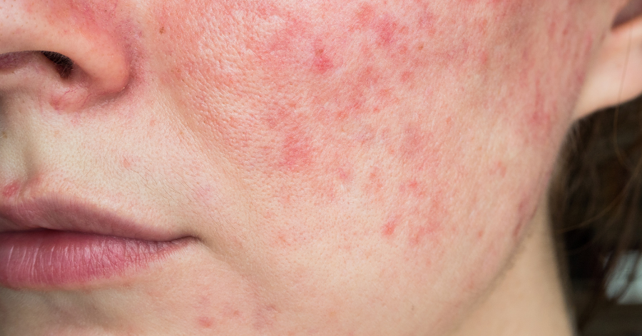 Sensitive and Reactive skin