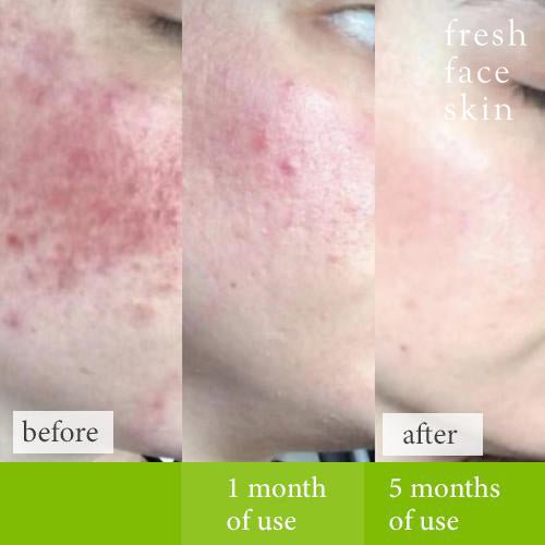 Soother Treatment - Fresh Face Skin