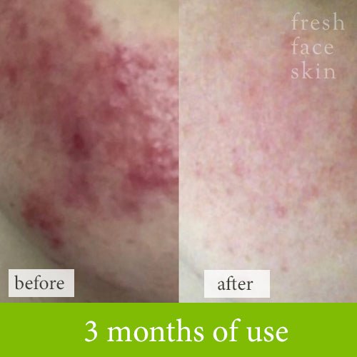 Soother Treatment - Fresh Face Skin