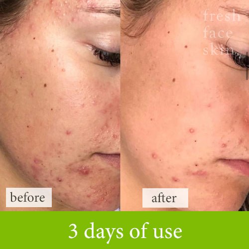Soother Treatment - Fresh Face Skin