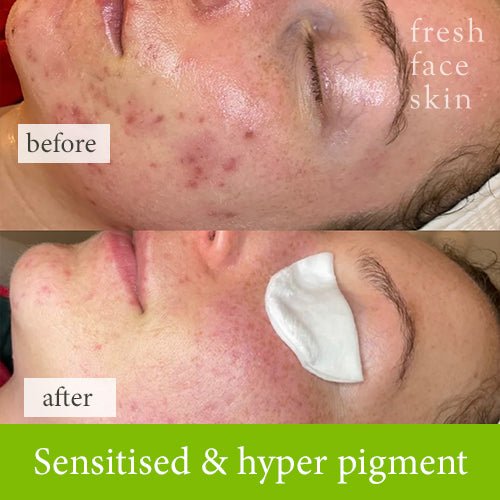AHA & Enzyme Exfoliator - Fresh Face Skin