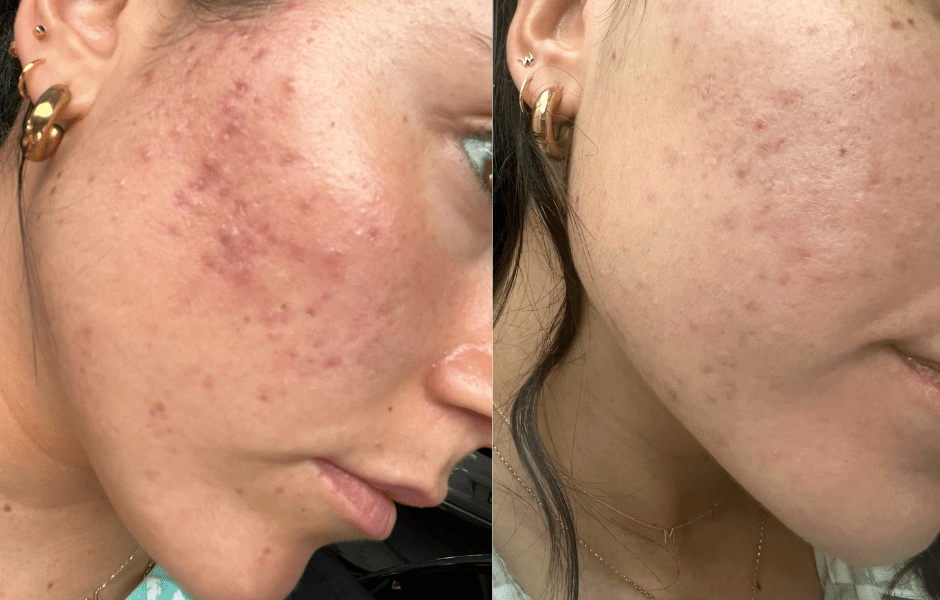 From Breakouts to Breakthroughs: My Journey to Clear Skin with Fresh Face Skin - Fresh Face Skin